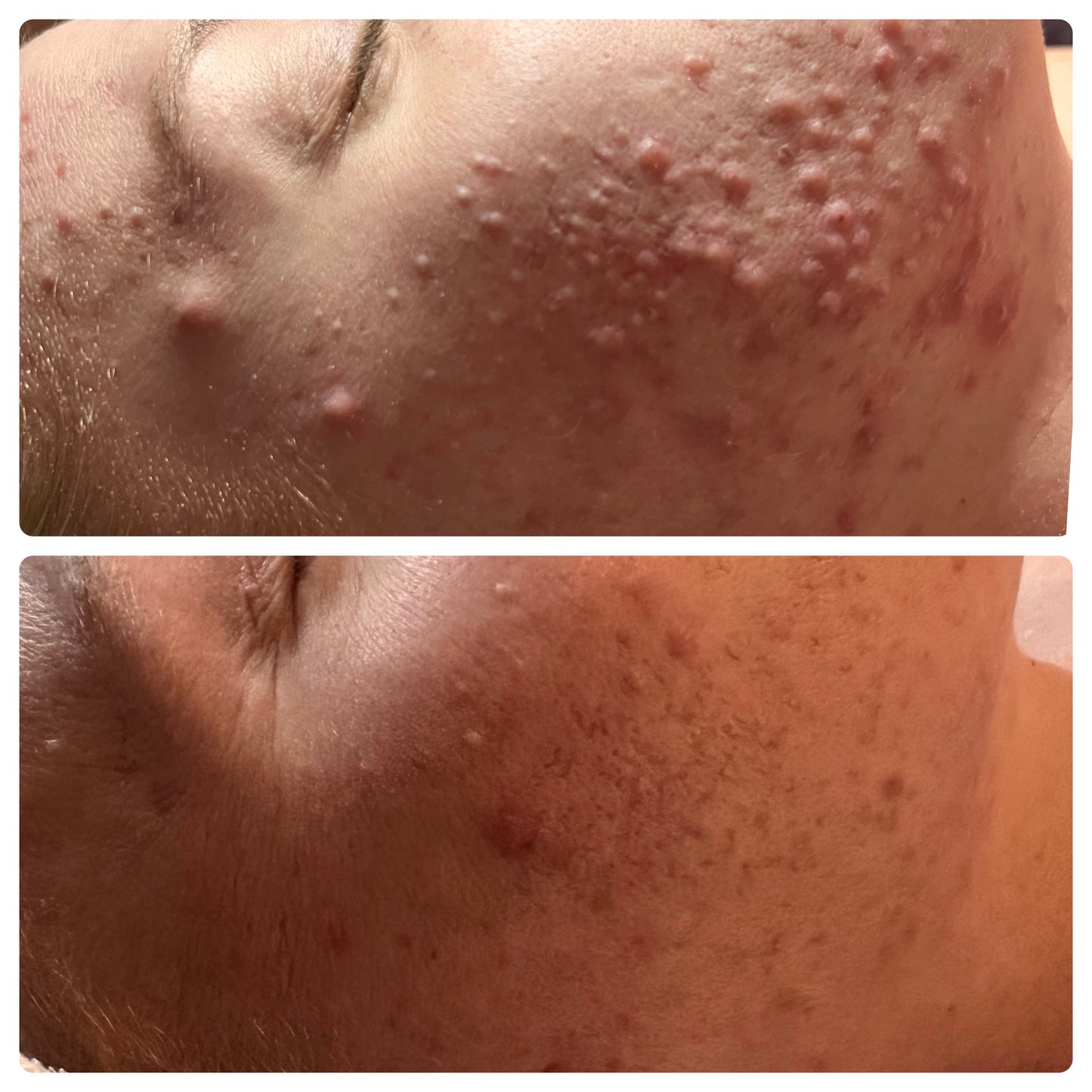 Emily’s Complete *Pregnancy Safe* Regimen for Hormonal Acne